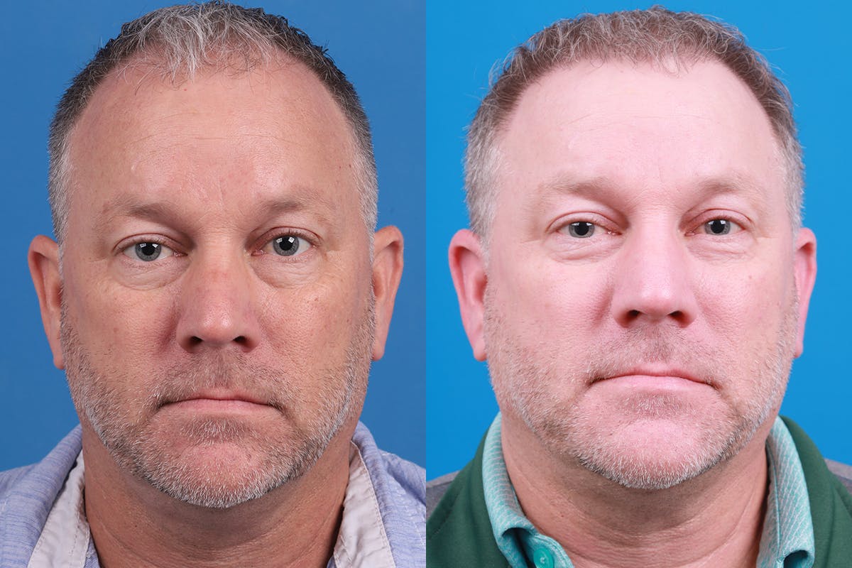 Hair Restoration Before & After Gallery - Patient 417692 - Image 1