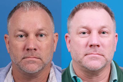Hair Restoration Before & After Gallery - Patient 417692 - Image 1