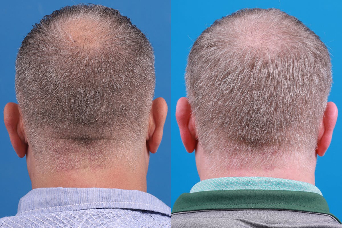 Hair Restoration Before & After Gallery - Patient 417692 - Image 3