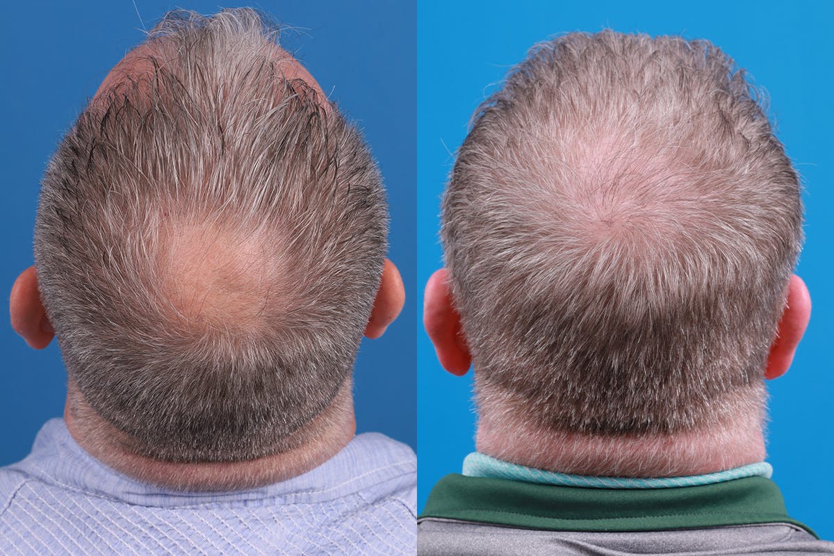 Hair Restoration Before & After Gallery - Patient 417692 - Image 2