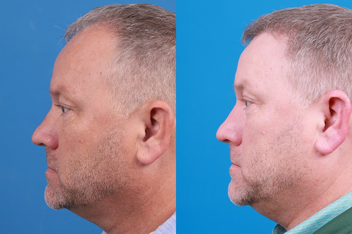 Hair Restoration Before & After Gallery - Patient 417692 - Image 7
