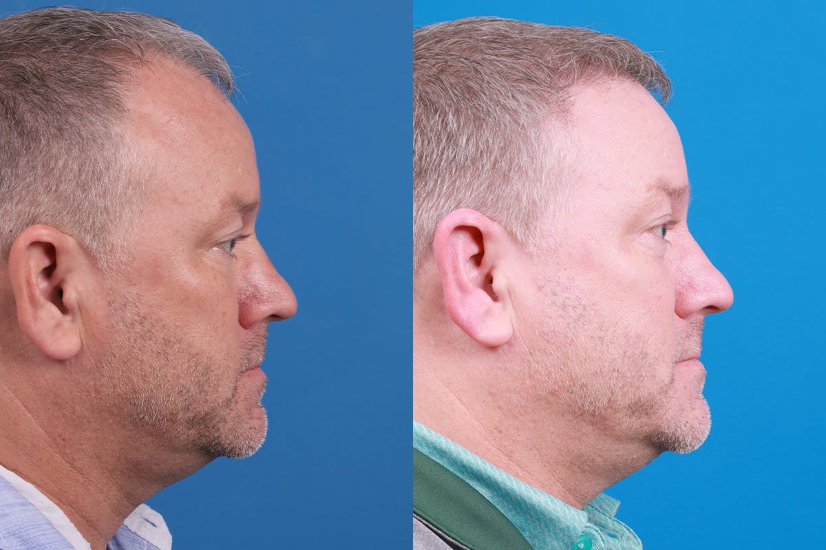 Hair Restoration Before & After Gallery - Patient 417692 - Image 6