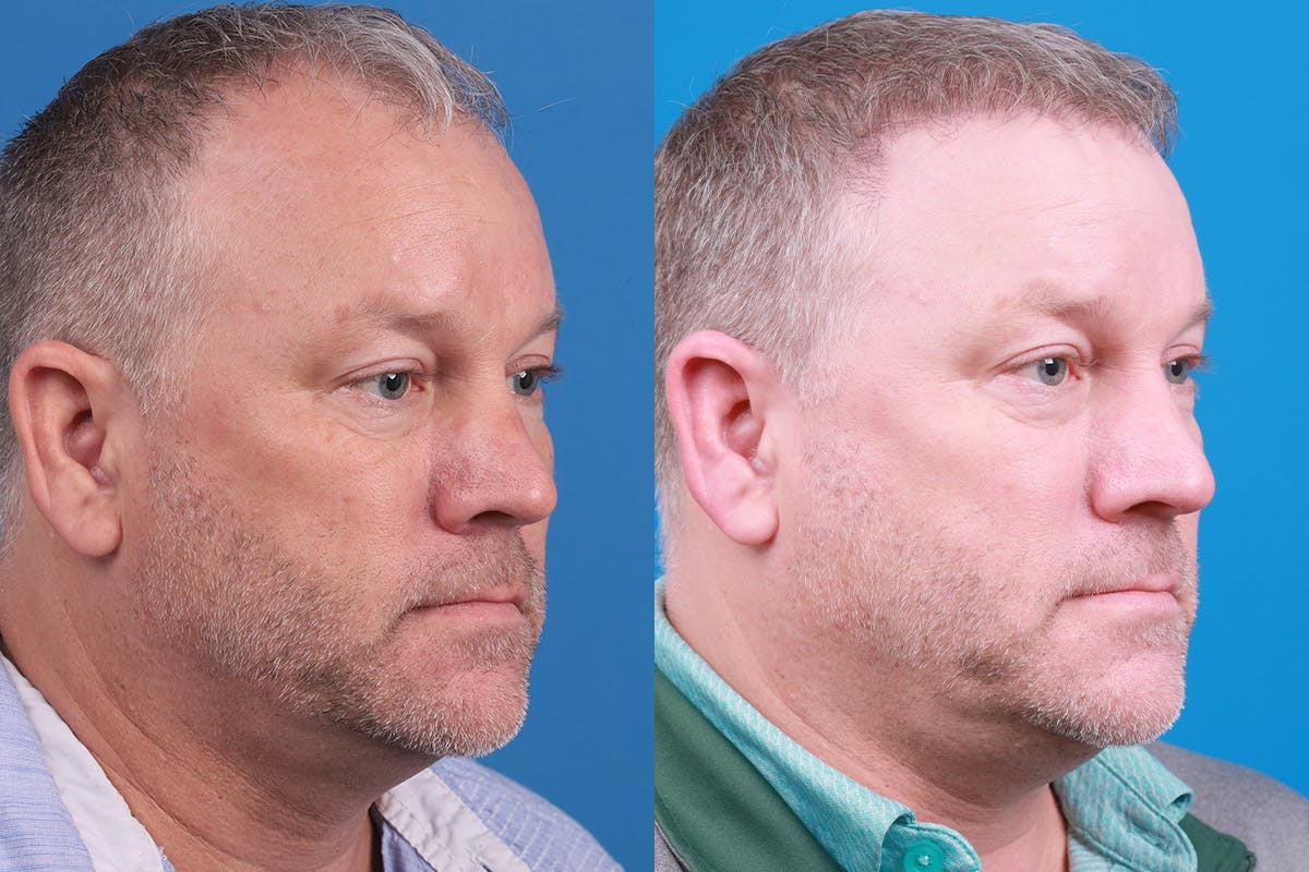 Hair Restoration Before & After Gallery - Patient 417692 - Image 5