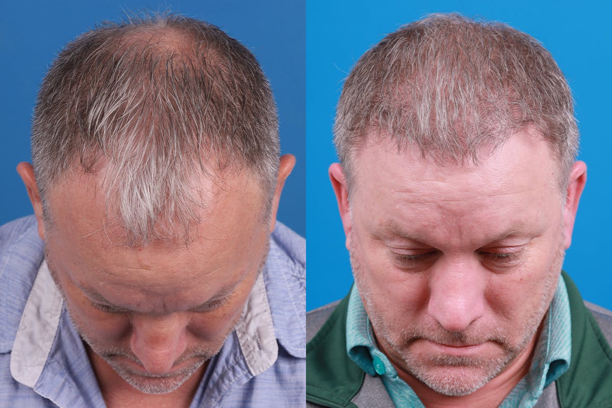 Hair Restoration Before & After Gallery - Patient 417692 - Image 4