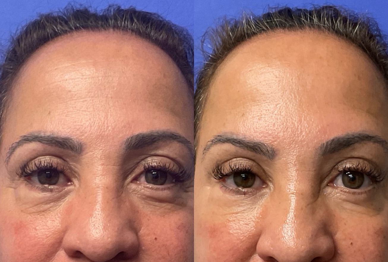 Dermal Fillers Before & After Gallery - Patient 258965 - Image 1