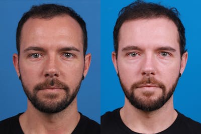 Hair Restoration Before & After Gallery - Patient 218038 - Image 1