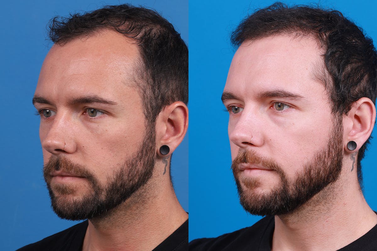 Hair Restoration Before & After Gallery - Patient 218038 - Image 5