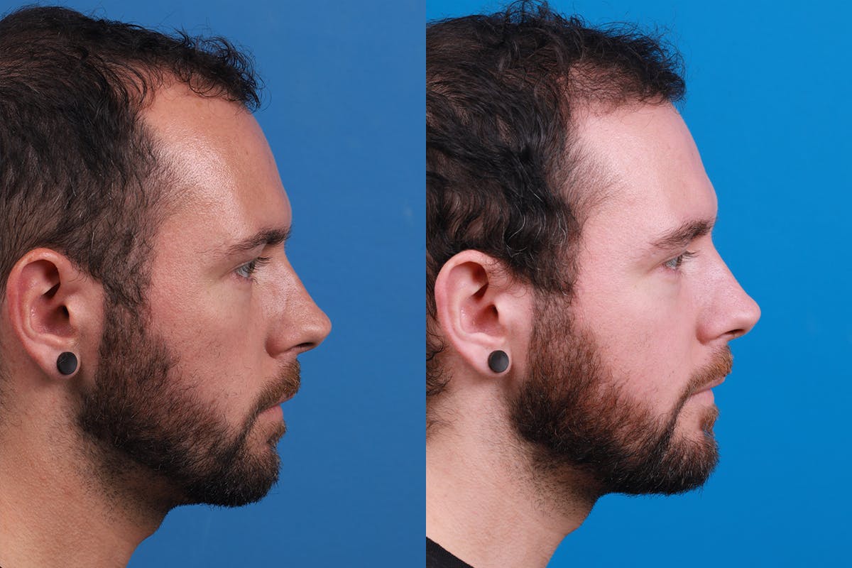 Hair Restoration Before & After Gallery - Patient 218038 - Image 3