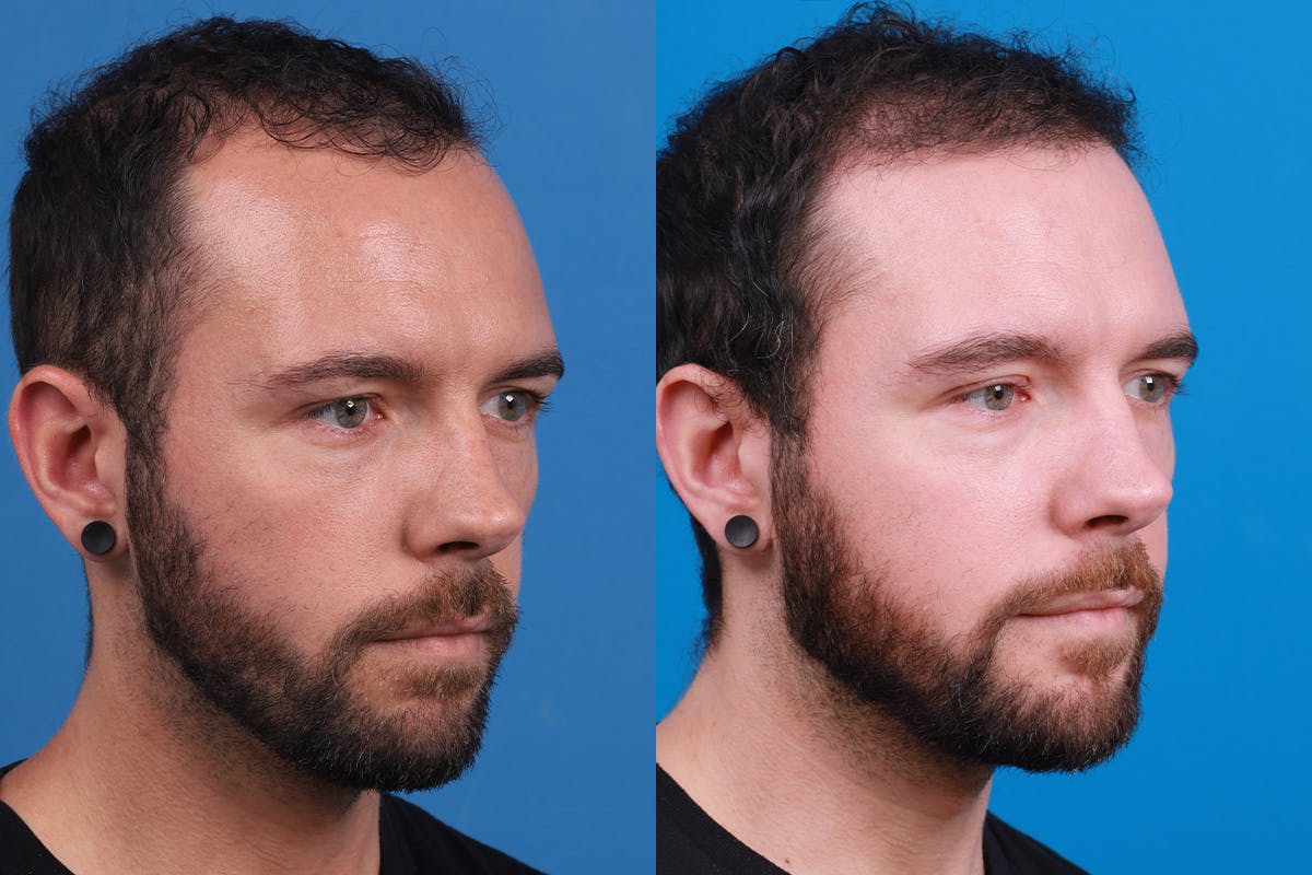 Hair Restoration Before & After Gallery - Patient 218038 - Image 2