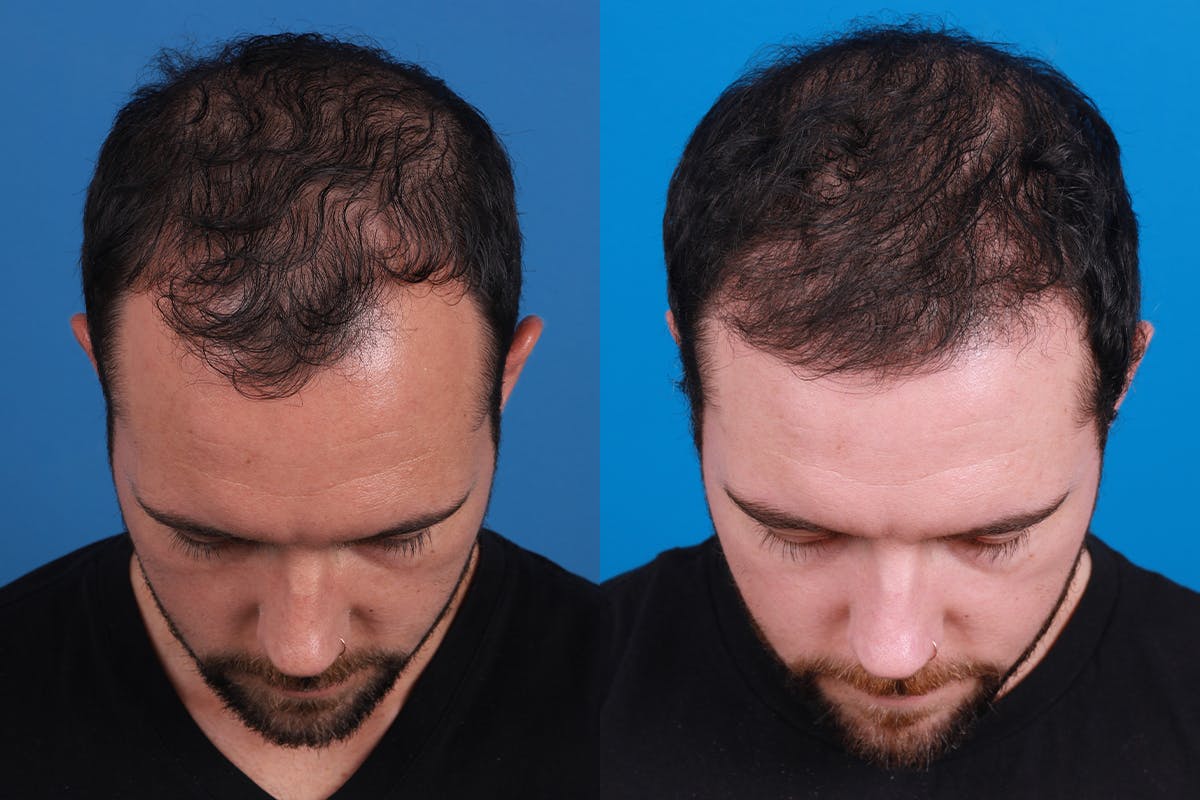 Hair Restoration Before & After Gallery - Patient 218038 - Image 6