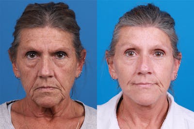 Facelift Before & After Gallery - Patient 256471 - Image 1