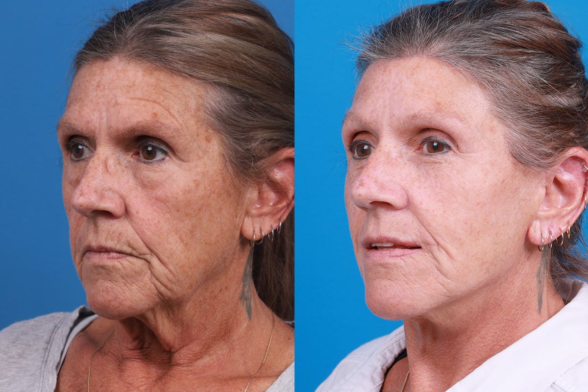 Skin Resurfacing Before & After Gallery - Patient 224873 - Image 4