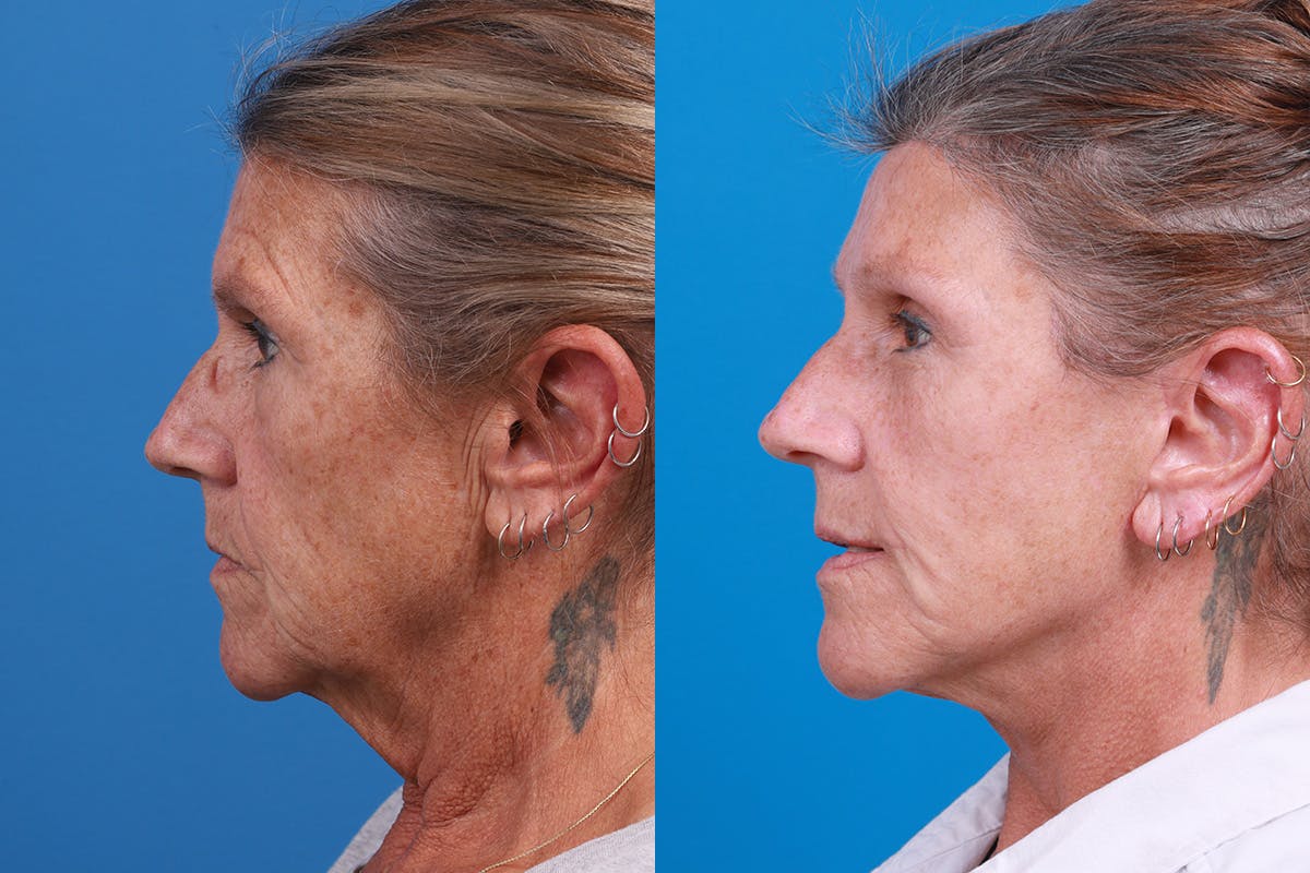 Skin Resurfacing Before & After Gallery - Patient 224873 - Image 5