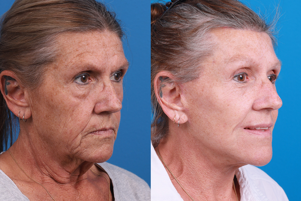 Brow Lift Before & After Gallery - Patient 310742 - Image 2