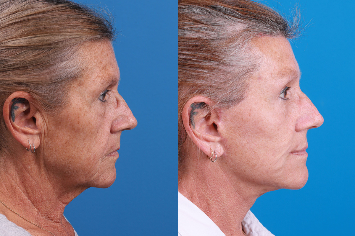Brow Lift Before & After Gallery - Patient 310742 - Image 3
