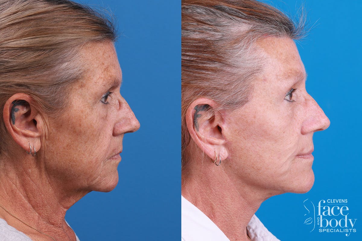 Eyelid Surgery Before & After Gallery - Patient 130924 - Image 3