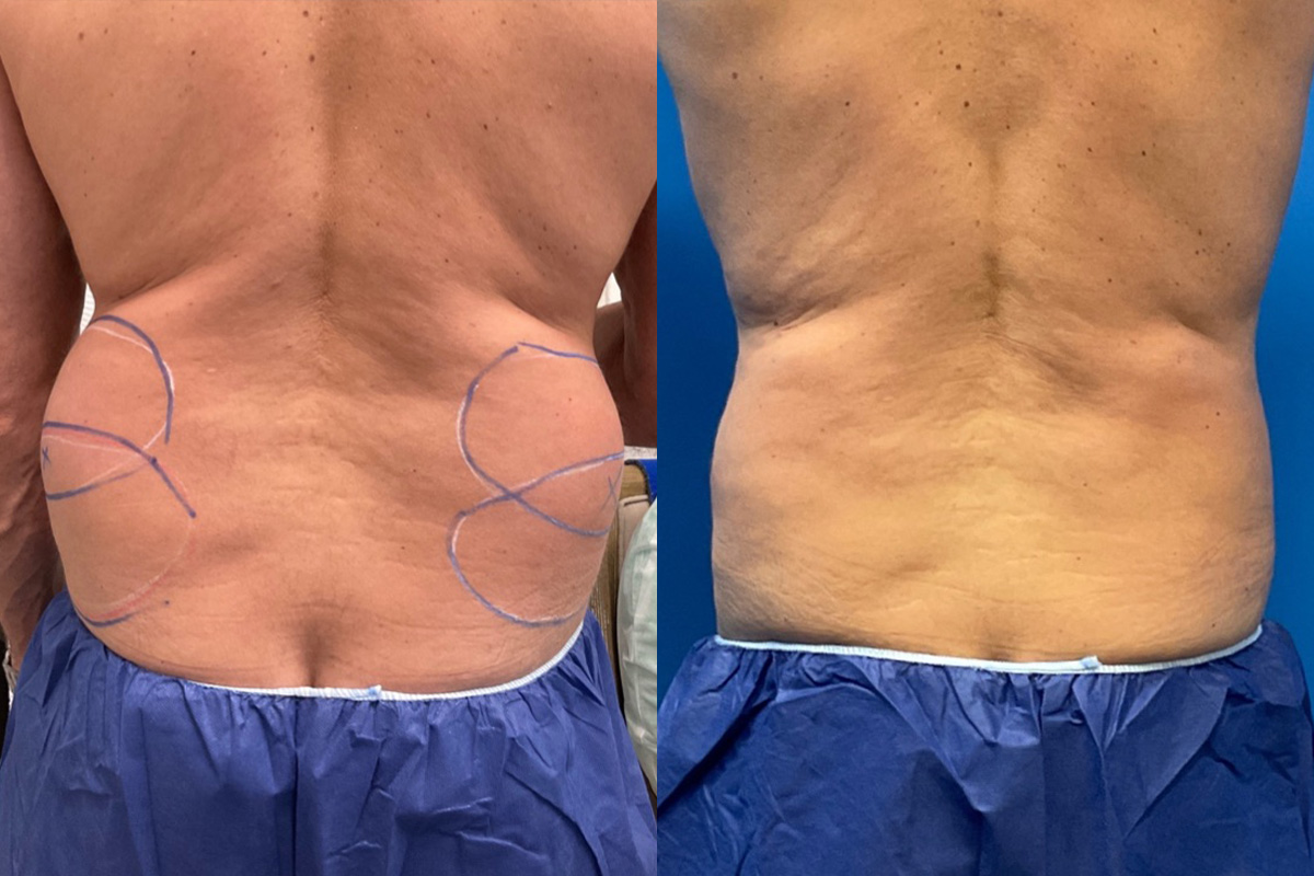 CoolSculpting Before & After Gallery - Patient 206167 - Image 1