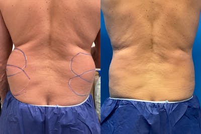 CoolSculpting Before & After Gallery - Patient 542268 - Image 1