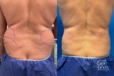 CoolSculpting Before & After Gallery - Patient 206167 - Image 1