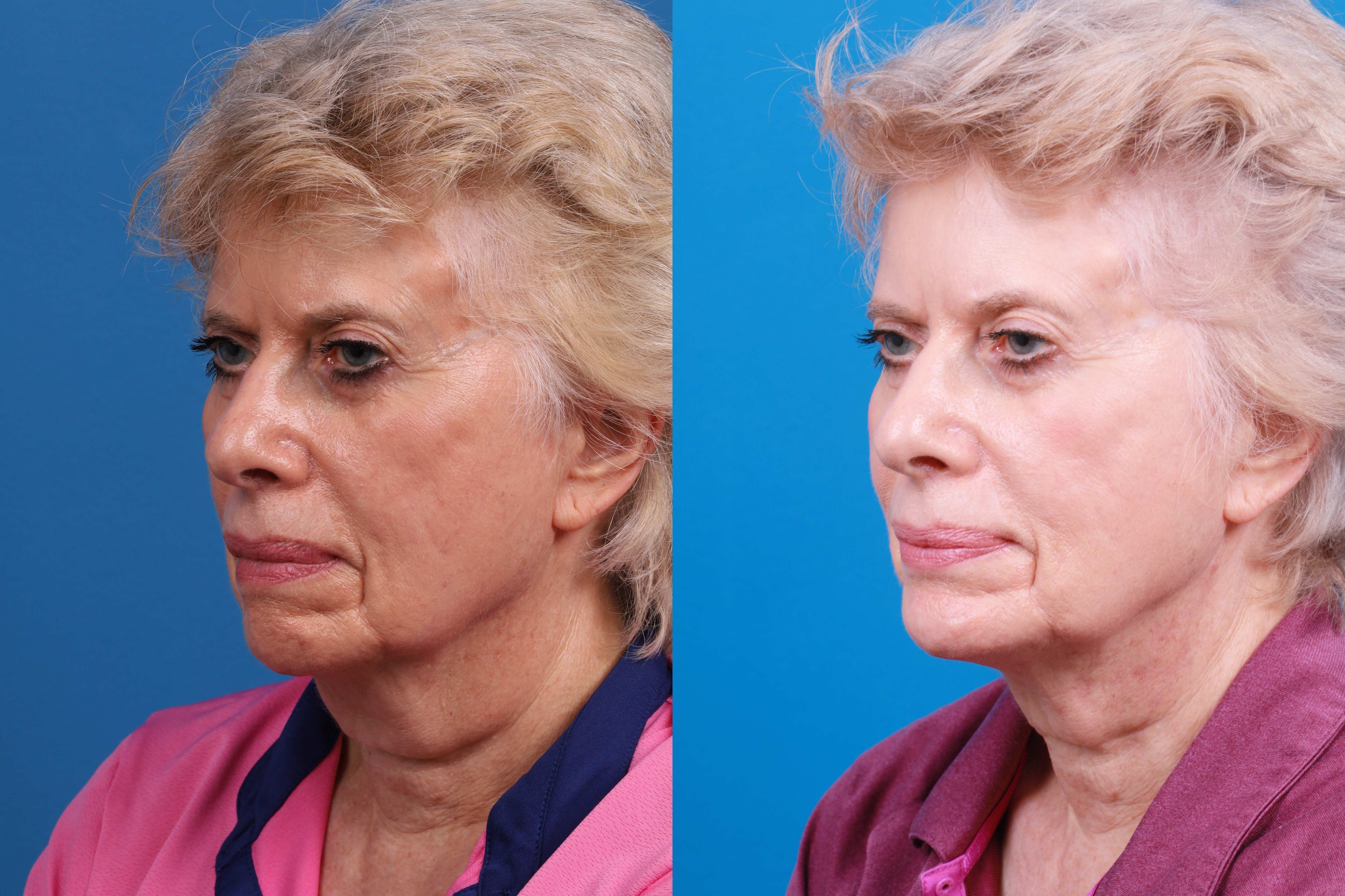 Chin Augmentation Before & After Gallery - Patient 114051 - Image 5