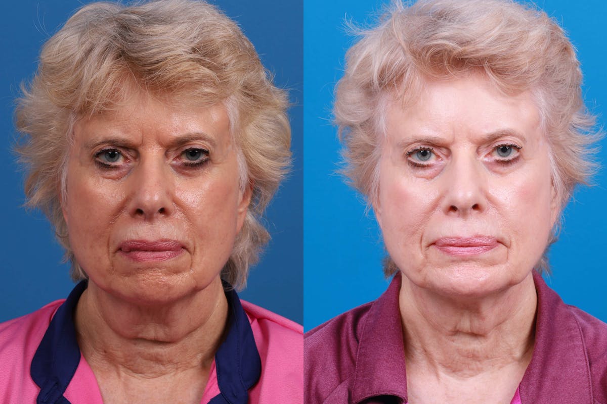 Chin Augmentation Before & After Gallery - Patient 114051 - Image 2