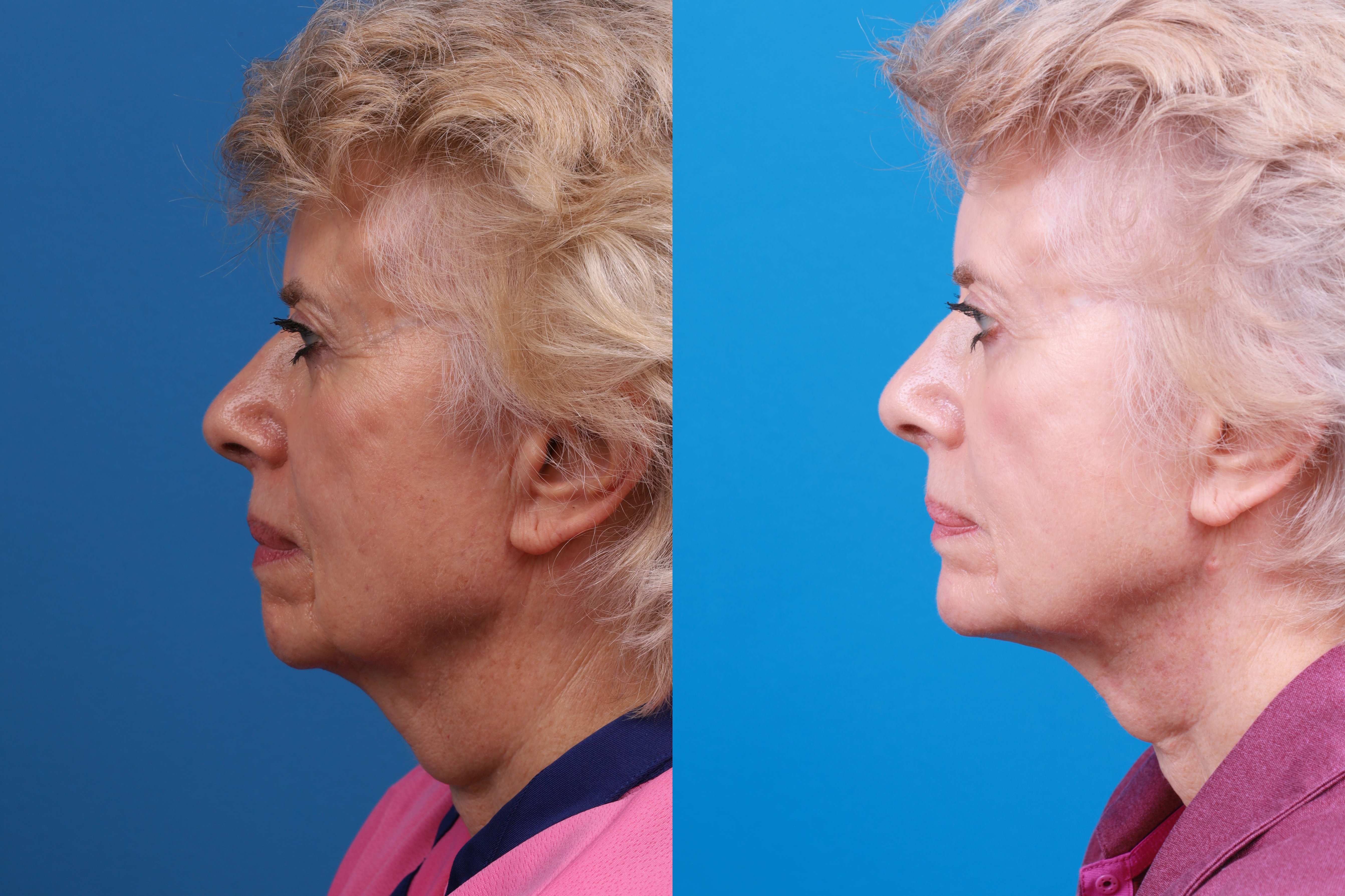 Chin Augmentation Before & After Gallery - Patient 114051 - Image 1