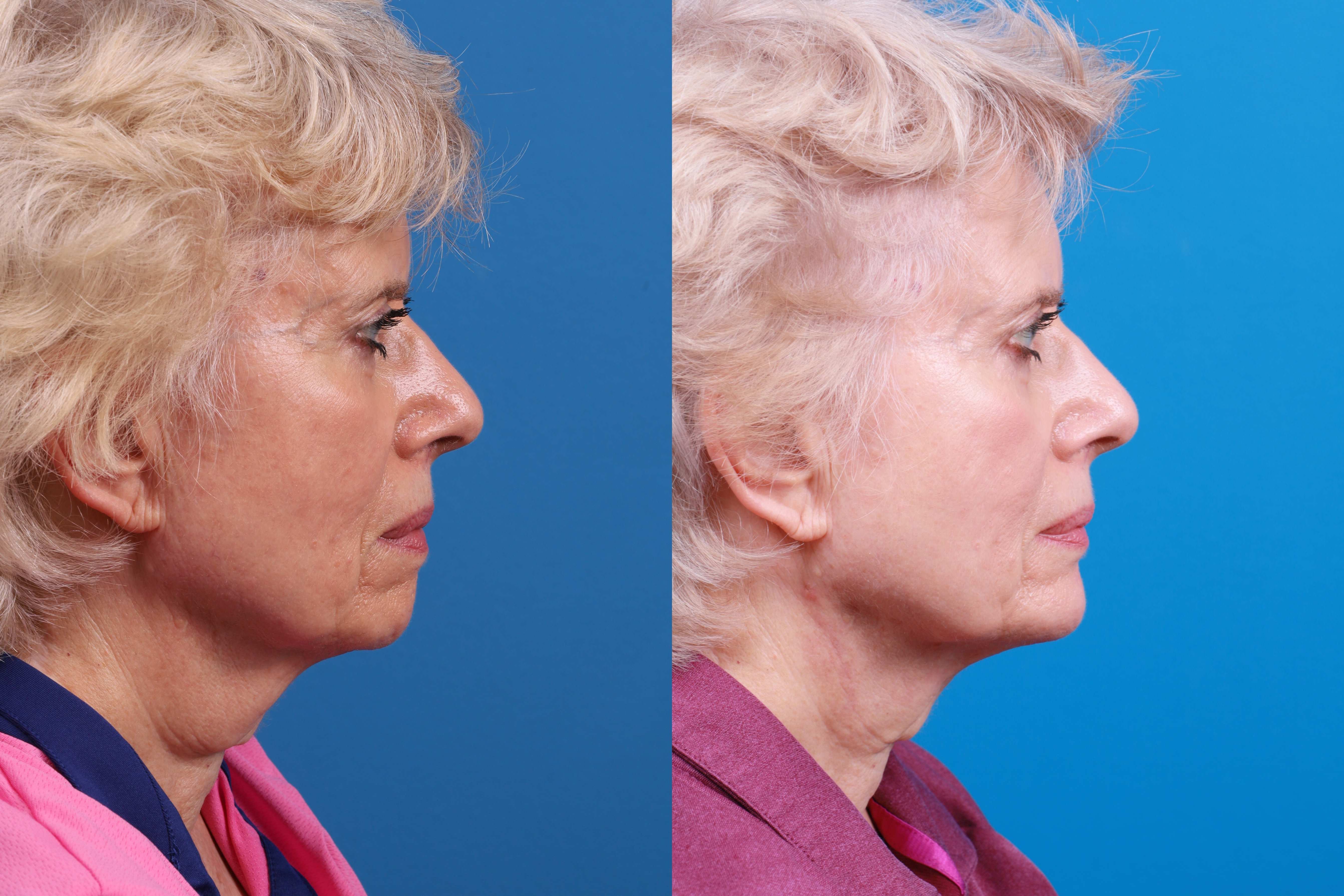 Chin Augmentation Before & After Gallery - Patient 114051 - Image 4