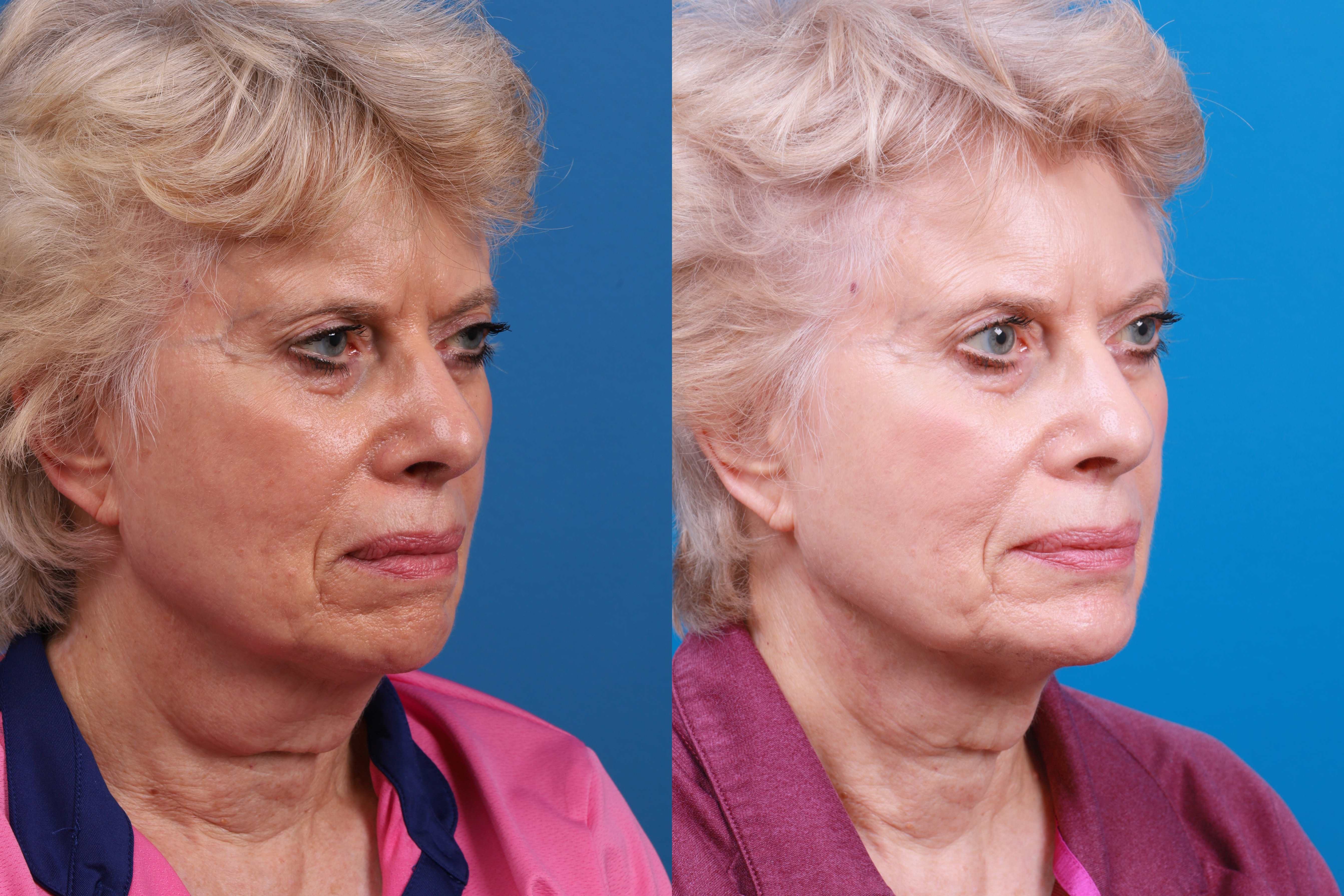 Chin Augmentation Before & After Gallery - Patient 114051 - Image 3