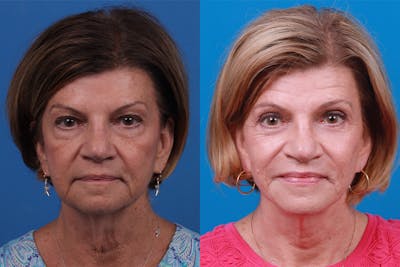 Facelift Before & After Gallery - Patient 416507 - Image 1