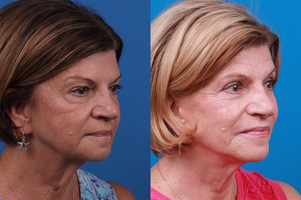 Facelift Before & After Gallery - Patient 416507 - Image 2