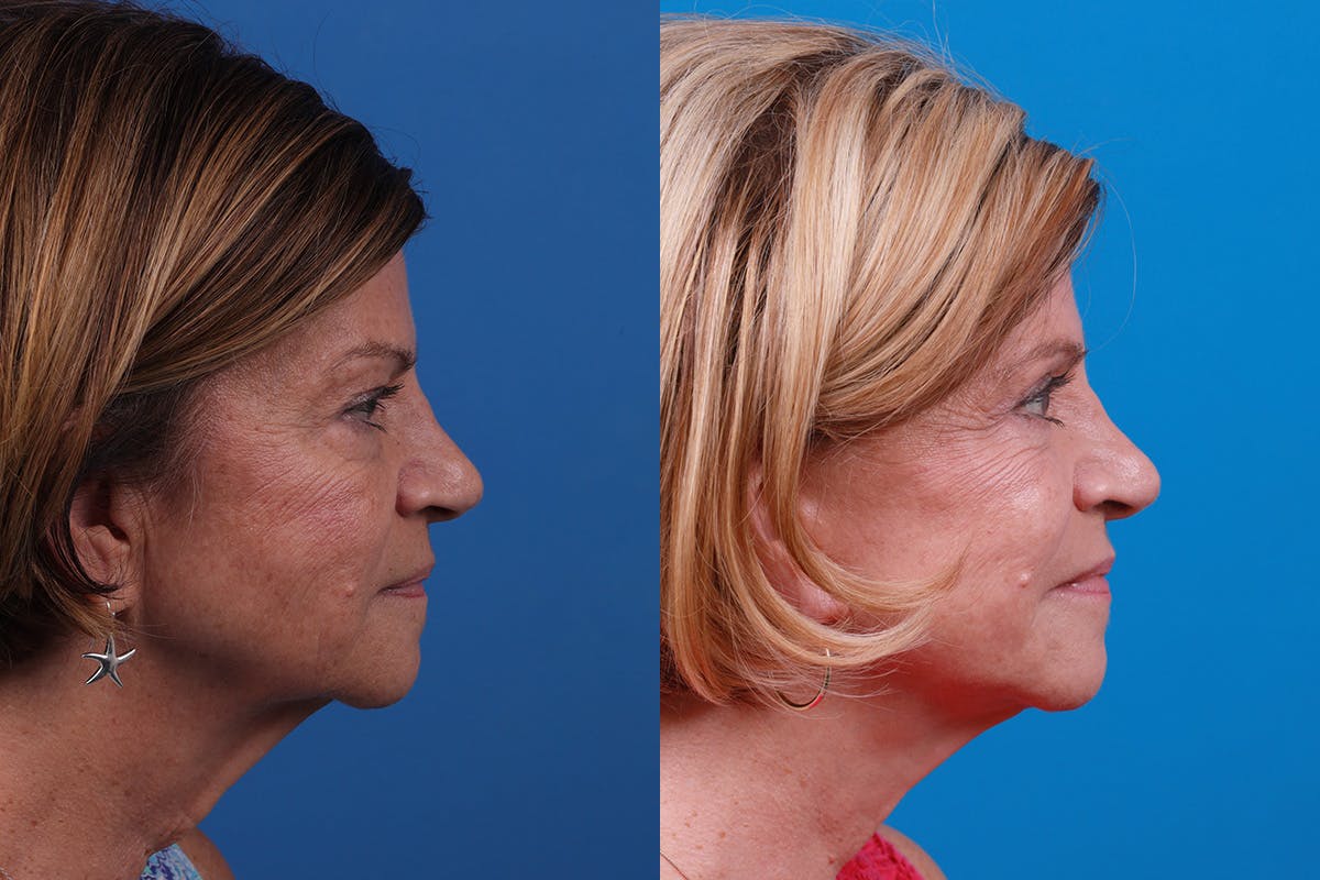 Facelift Before & After Gallery - Patient 416507 - Image 3