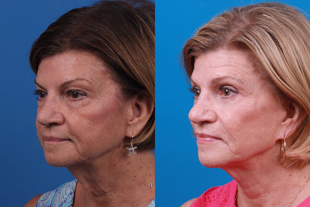 Facelift Before & After Gallery - Patient 416507 - Image 4