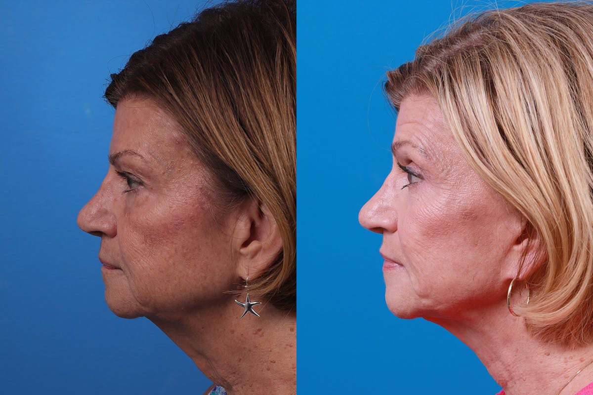 Facelift Before & After Gallery - Patient 416507 - Image 5