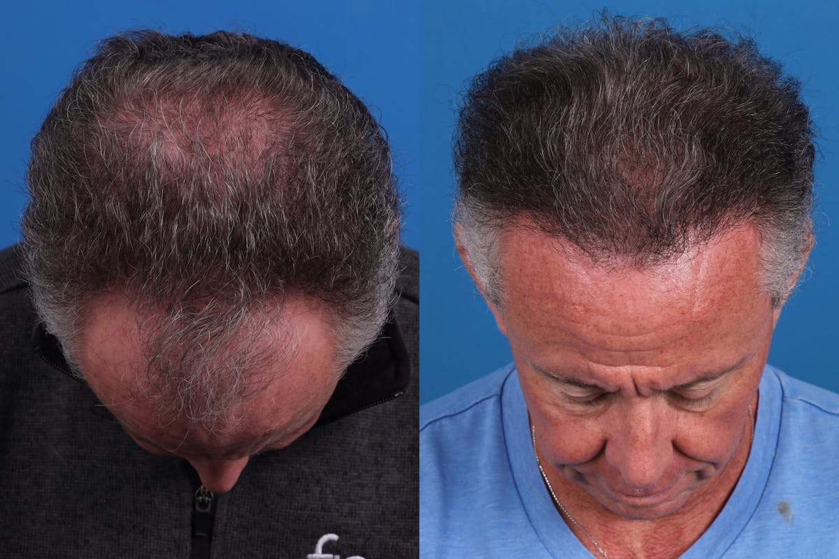 Hair Restoration Before & After Gallery - Patient 169556 - Image 6