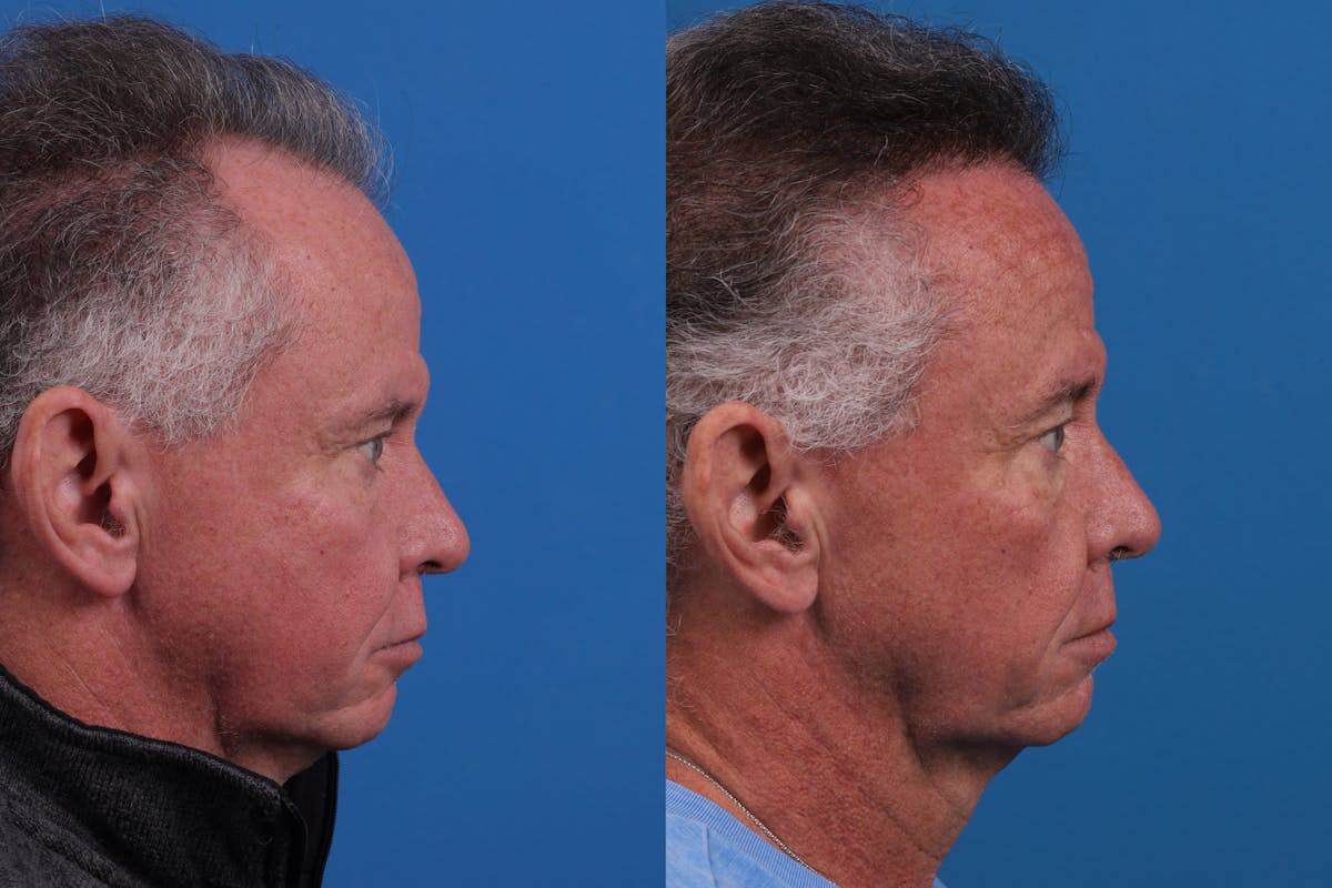 Hair Restoration Before & After Gallery - Patient 169556 - Image 5