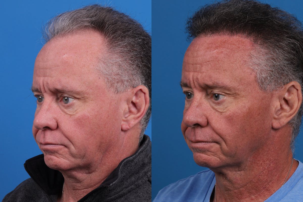 Hair Restoration Before & After Gallery - Patient 169556 - Image 2
