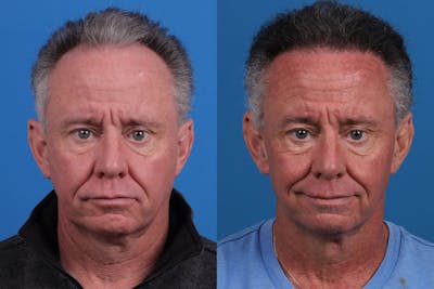 Hair Restoration Before & After Gallery - Patient 169556 - Image 1