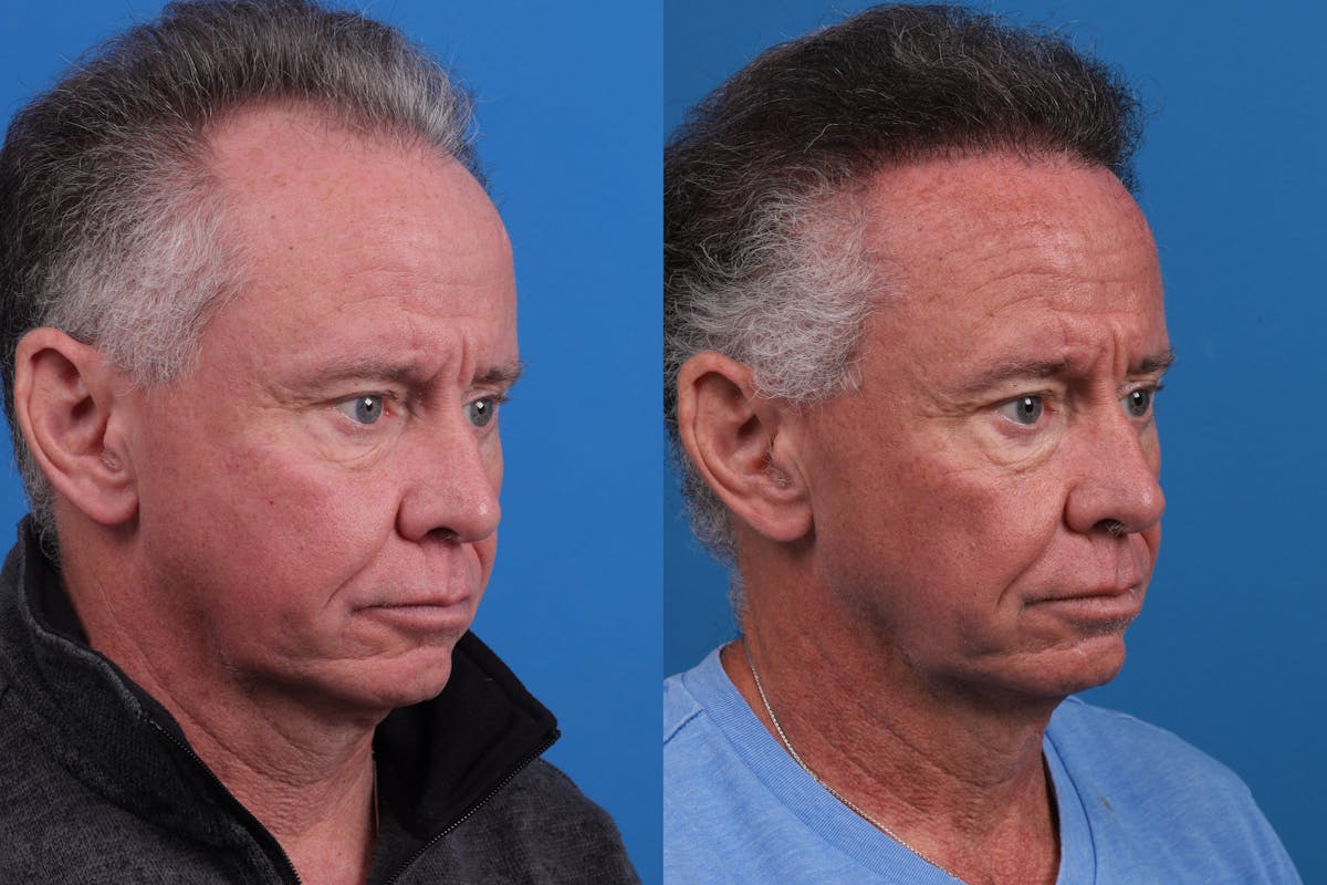 Hair Restoration Before & After Gallery - Patient 169556 - Image 4
