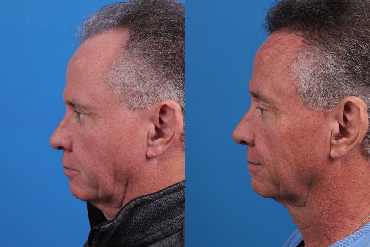 Hair Restoration Before & After Gallery - Patient 169556 - Image 3