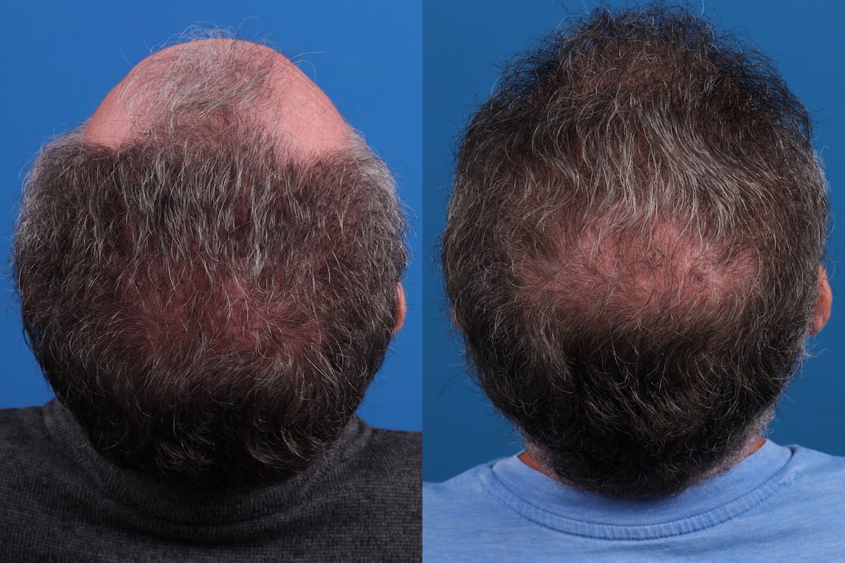 Hair Restoration Before & After Gallery - Patient 169556 - Image 7