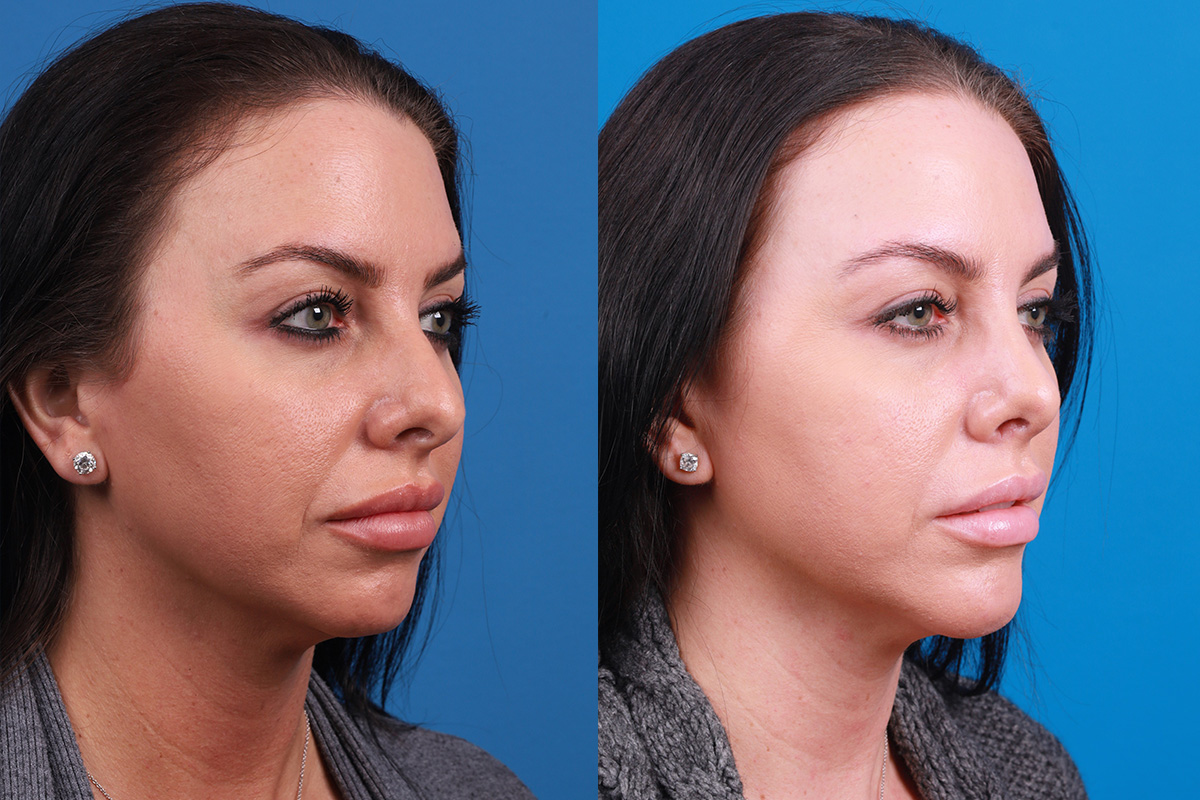 Chin Augmentation Before & After Gallery - Patient 319882 - Image 3