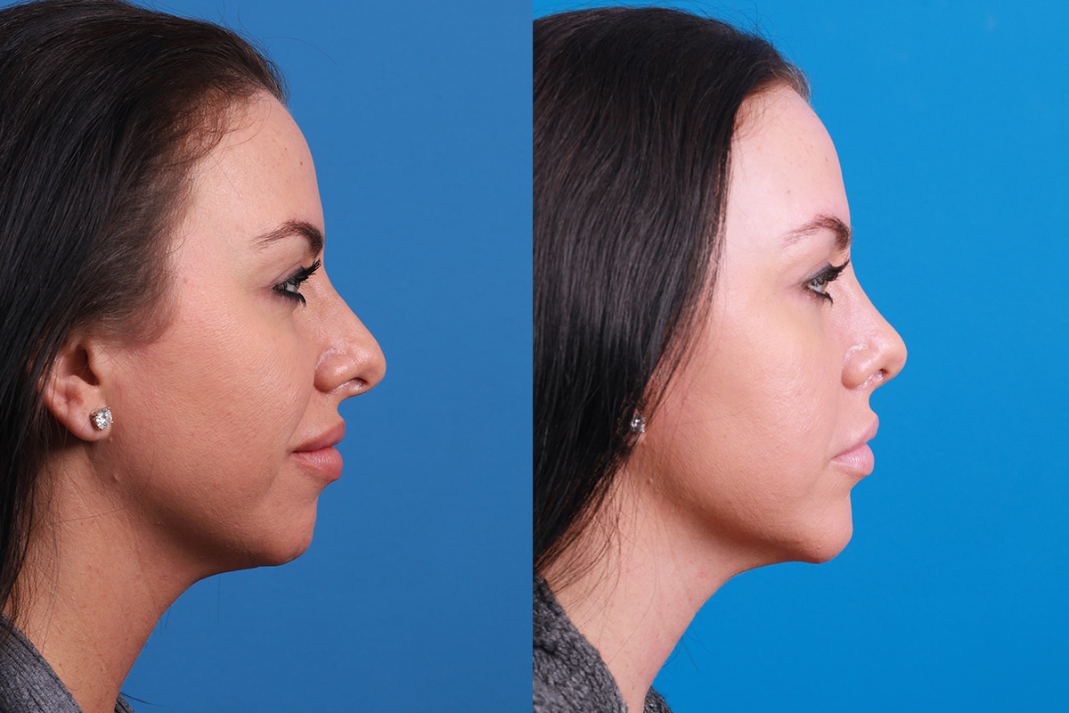 Chin Augmentation Before & After Gallery - Patient 319882 - Image 4