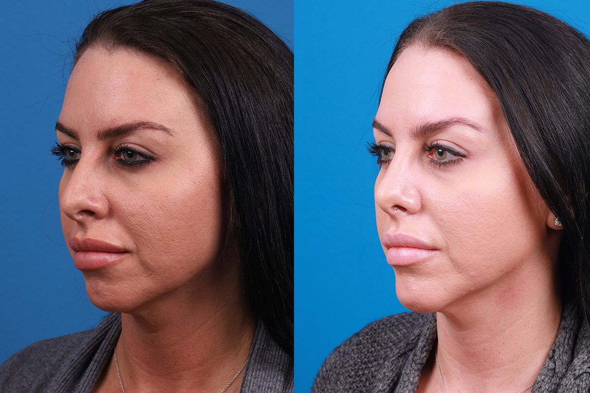Chin Augmentation Before & After Gallery - Patient 319882 - Image 5
