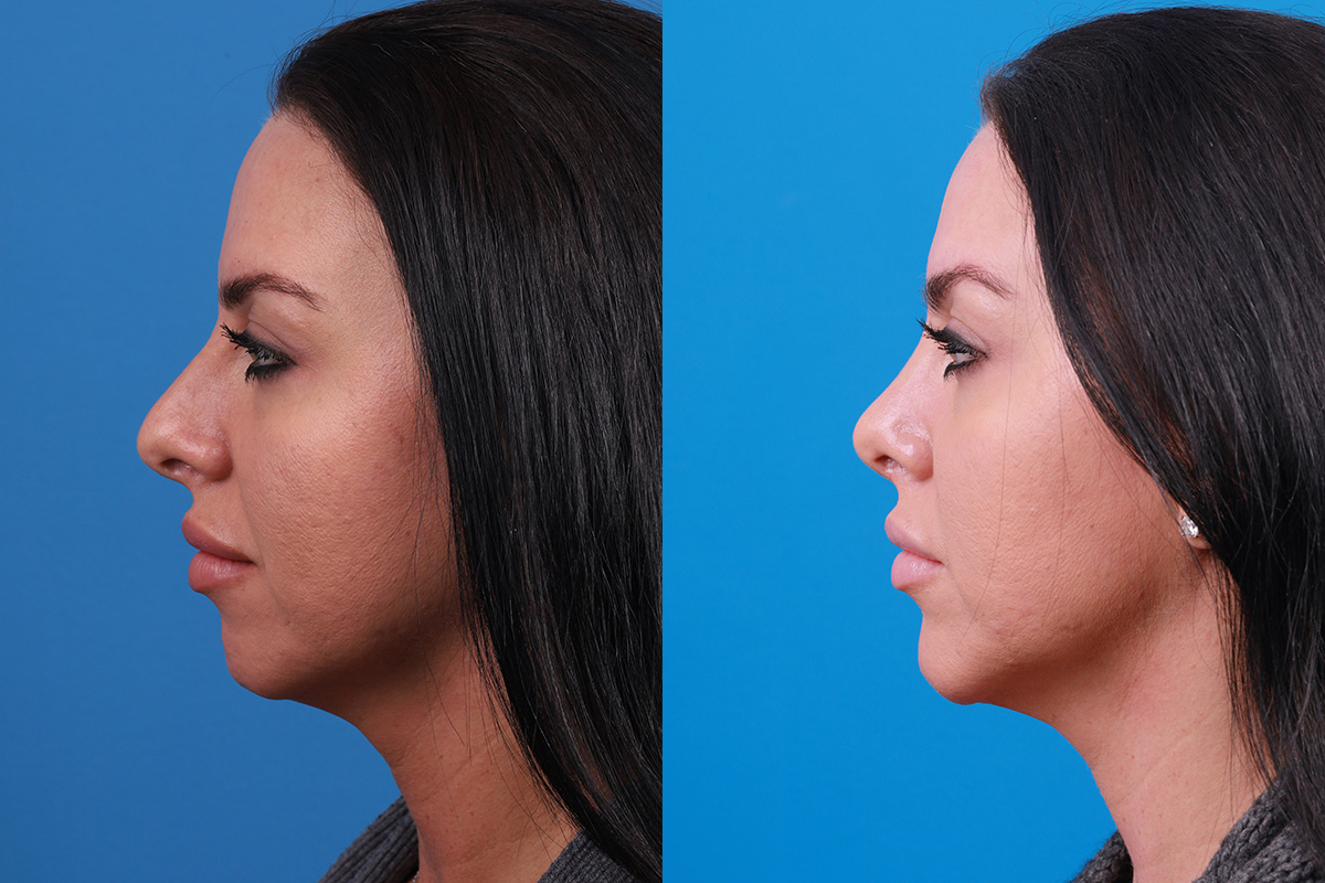 Chin Augmentation Before & After Gallery - Patient 319882 - Image 1