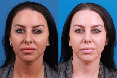Rhinoplasty Before & After Gallery - Patient 146034 - Image 1
