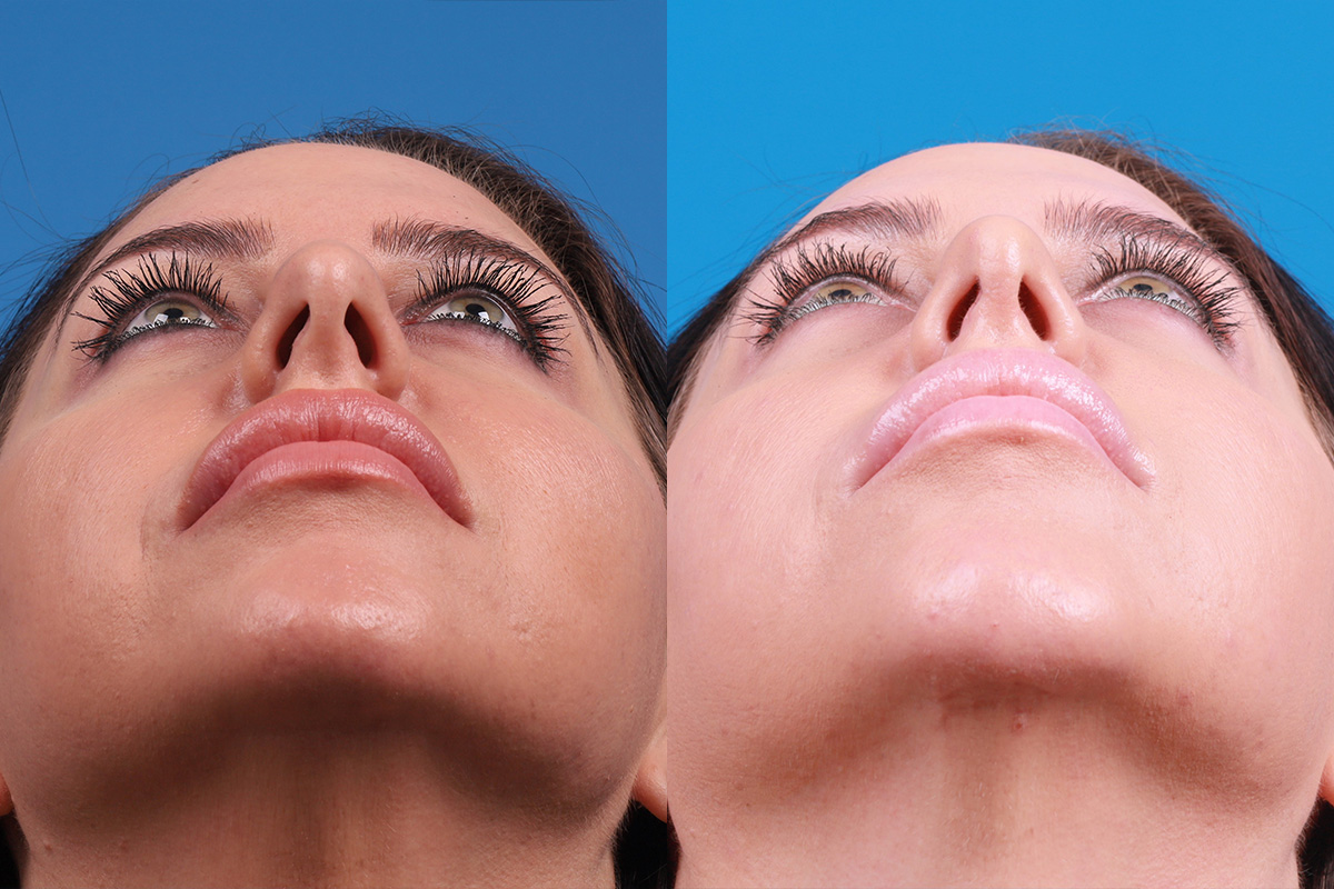 Chin Augmentation Before & After Gallery - Patient 319882 - Image 6