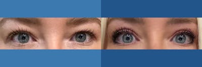 Eyelid Surgery Before & After Gallery - Patient 175972 - Image 1