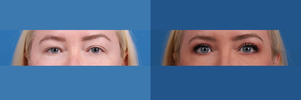 Eyelid Surgery Before & After Gallery - Patient 175972 - Image 2