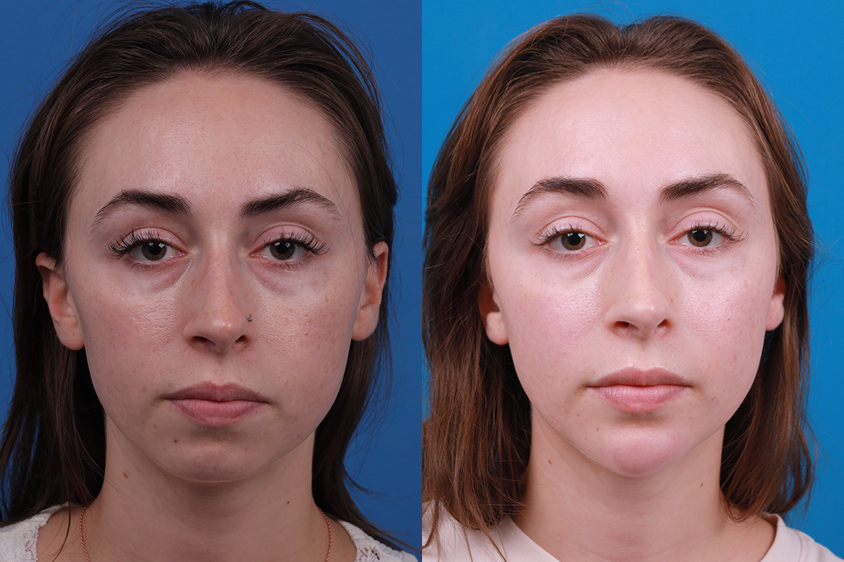 Dermal Fillers Before & After Gallery - Patient 388098 - Image 1