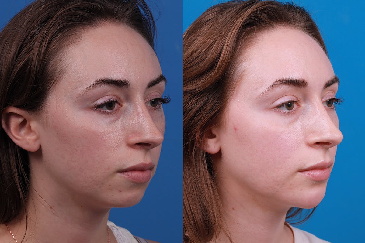 Dermal Fillers Before & After Gallery - Patient 388098 - Image 2